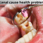 can root canal cause health problems